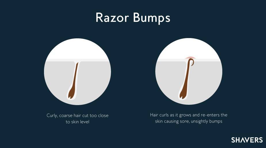 Prevent Ingrown Hairs and Razor Bumps - Shaving Tips for Black Men / Advice  & Knowledge
